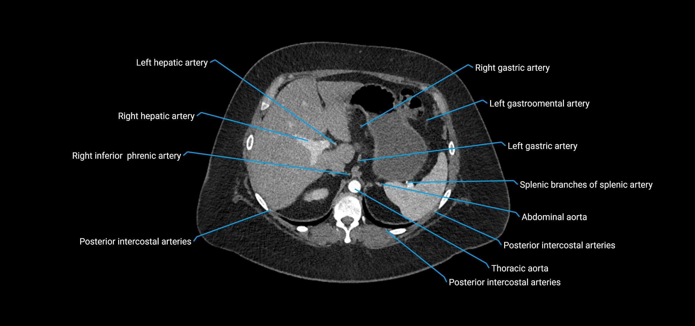 CTA abdomen axial cross sectional anatomy labelled image_41 (2).webp